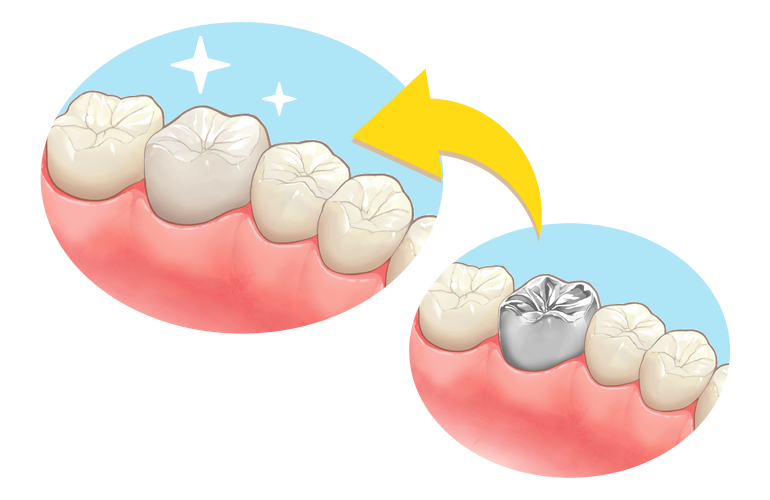セラミック治療は福井市の歯科 歯医者 高垣歯科へ 審美歯科